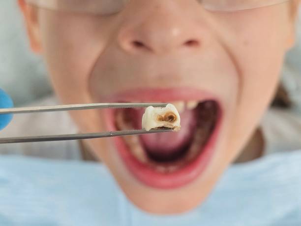 Best Emergency Tooth Extraction in Thorsby, AL