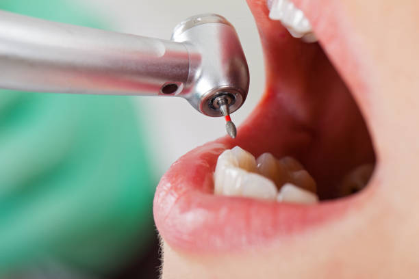 Best Emergency Wisdom Teeth Removal in Thorsby, AL